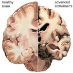 Do You Have Rickets of the Brain?